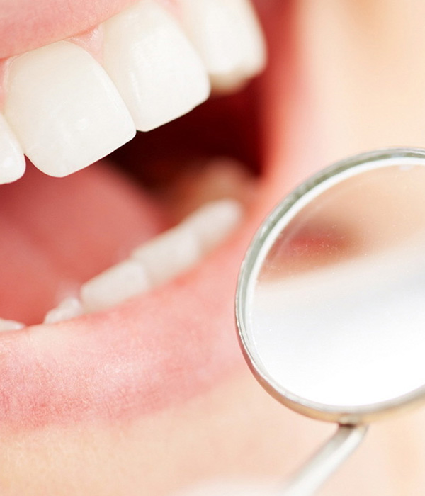 Blanqueamiento dental